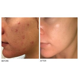 Alpha Beta® - Exfoliant formula intensa