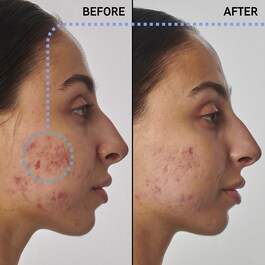 1% Retinol Serum - Ser impotriva cicatricelor, urmelor si ridurilor