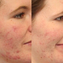 Blemish Clearing Solution - Tratament anti acneic