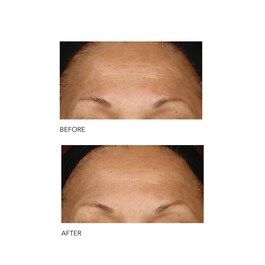 Alpha Beta® - Exfoliant formula intensa