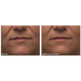 Alpha Beta® - Solutie exfoliere zilnica