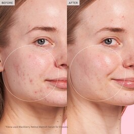 Blackberry Retinol - Ser de reinitializare