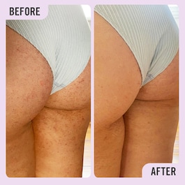 KP Bump Eraser Body Scrub with 10% AHA - Exfoliant pentru corp