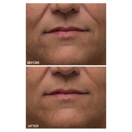 Alpha Beta® - Solutie exfoliere zilnica