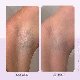 Ingrown Hair Pads - Discuri compostabile pentru peri incarnati x60