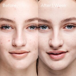 Blemish Clearing Solution - Tratament anti acneic
