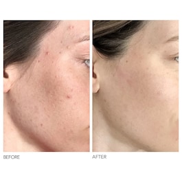 Alpha Beta® - Exfoliant formula universala