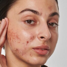1% Retinol Serum - Ser impotriva cicatricelor, urmelor si ridurilor
